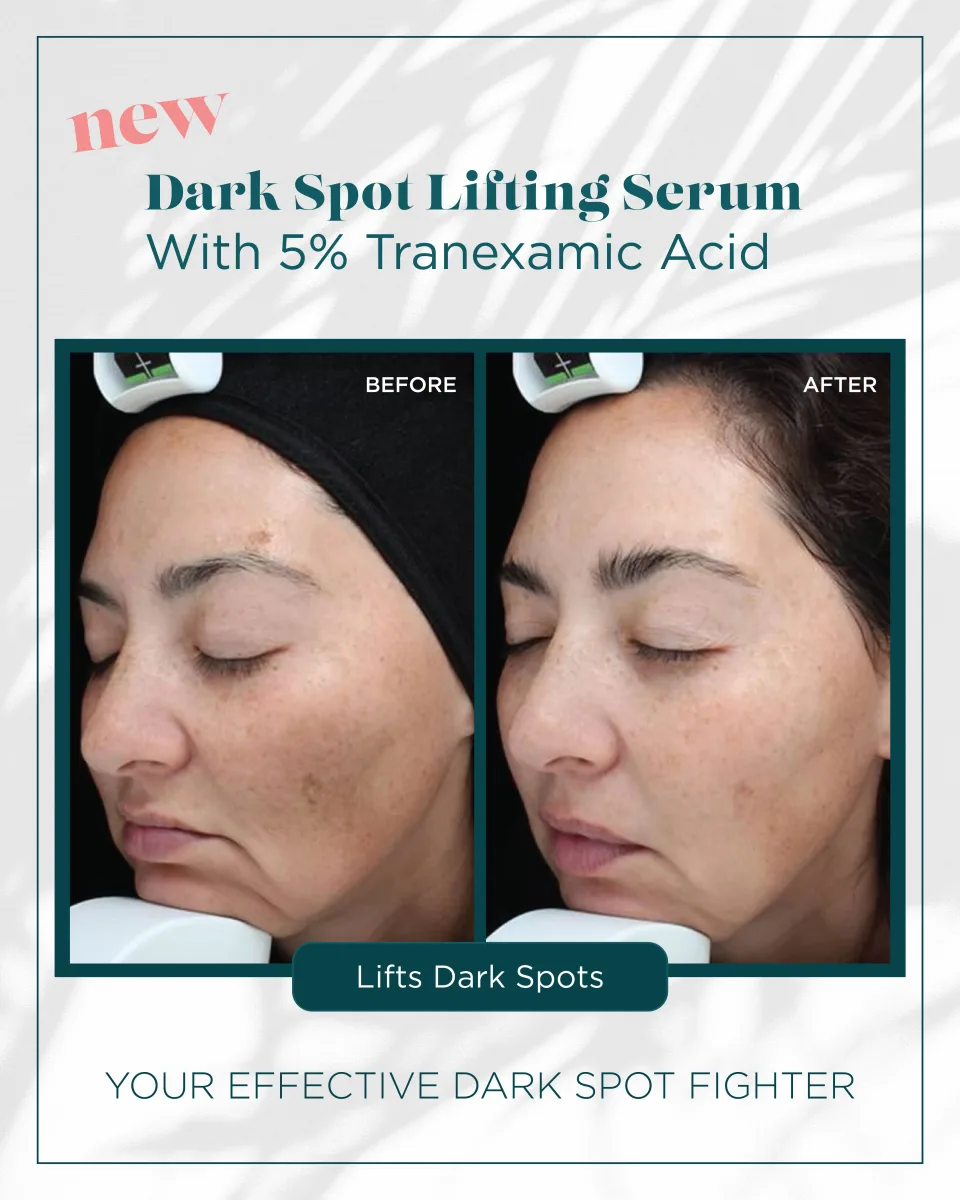 Facial dark spots before and after Dark Spot Lifting Serum — lifts dark spots