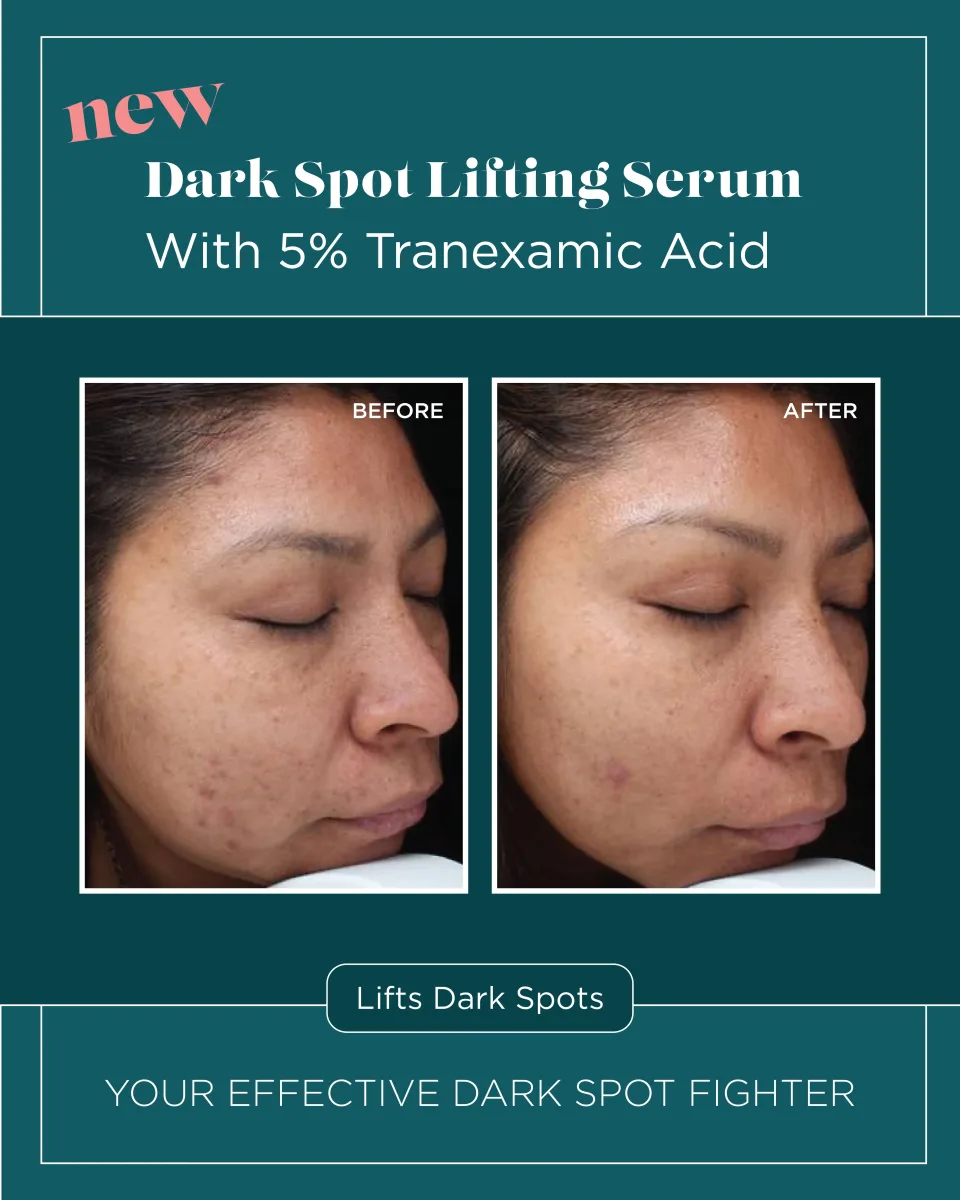 Facial dark spots before and after Dark Spot Lifting Serum 5% Tranexamic Acid
