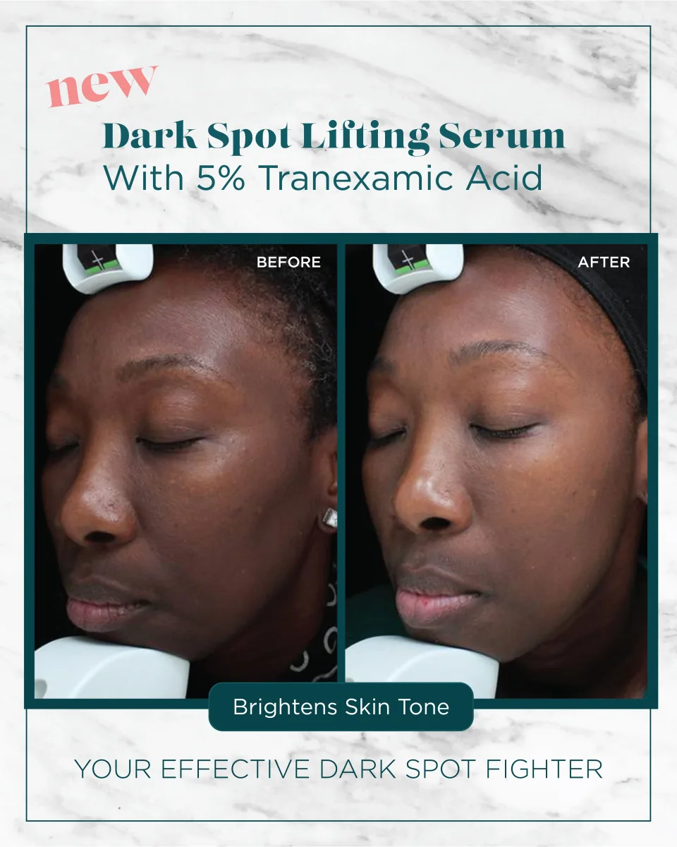 Very deep skin tone dark spots before and after Dark Spot Lifting Serum — brightens skin tone