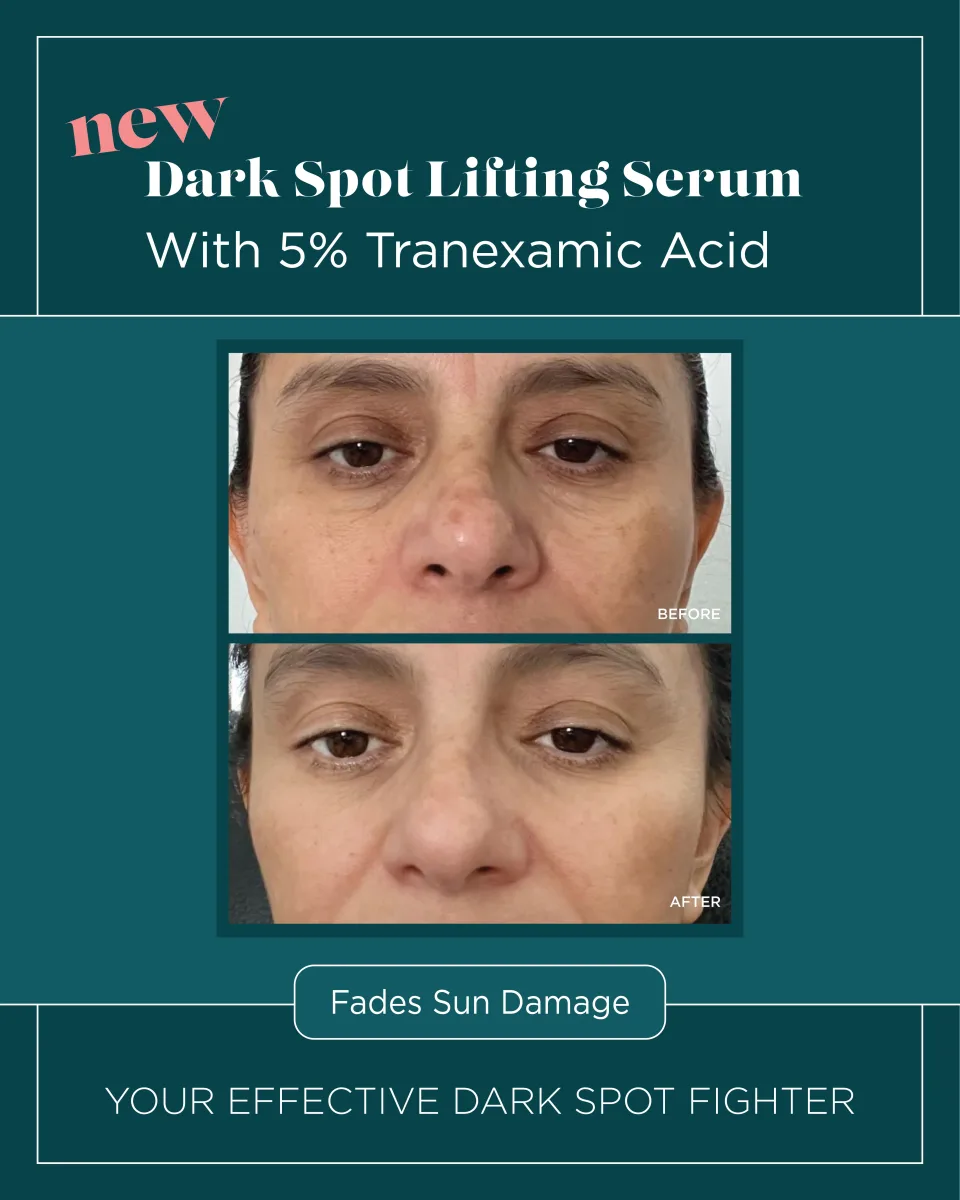 Facial sun damage before and after Dark Spot Lifting Serum with 5% Tranexamic Acid