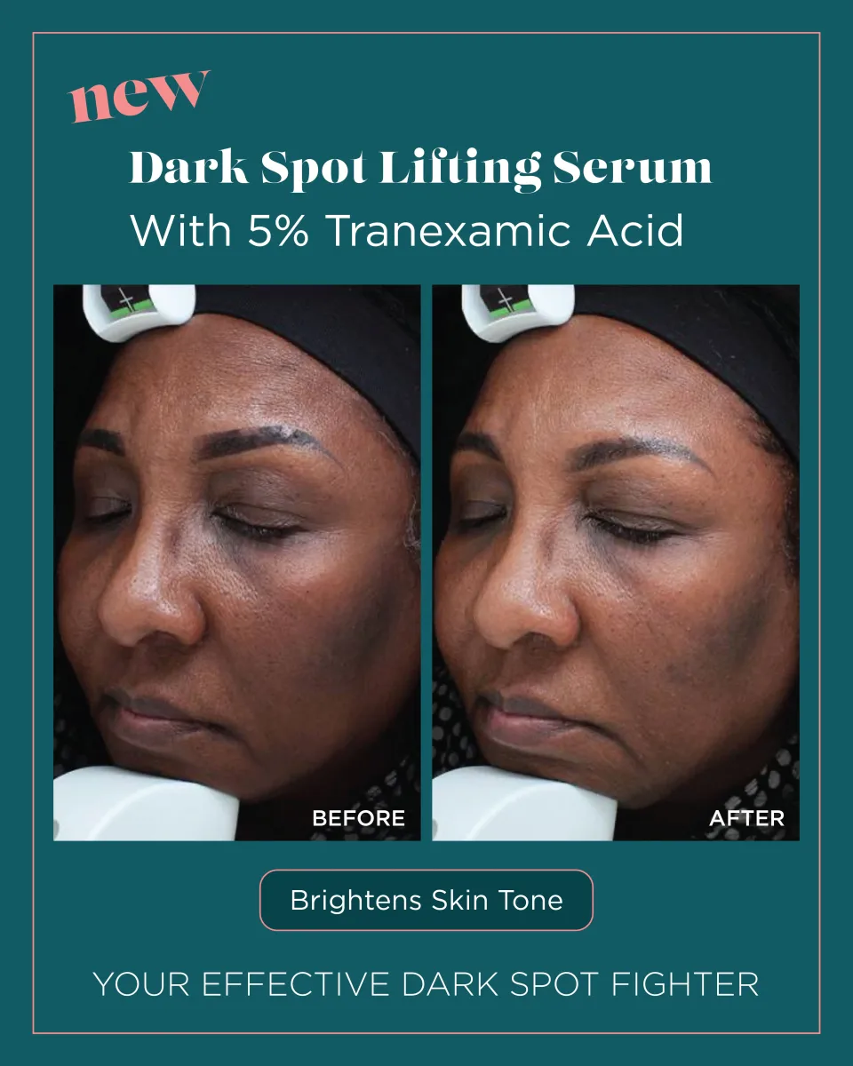 Dark spots and uneven tone before and after Dark Spot Lifting Serum — brightens skin tone