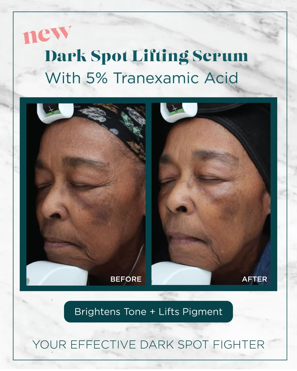 Deep skin tone pigmentation before and after Dark Spot Lifting Serum — brightens tone and lifts pigment