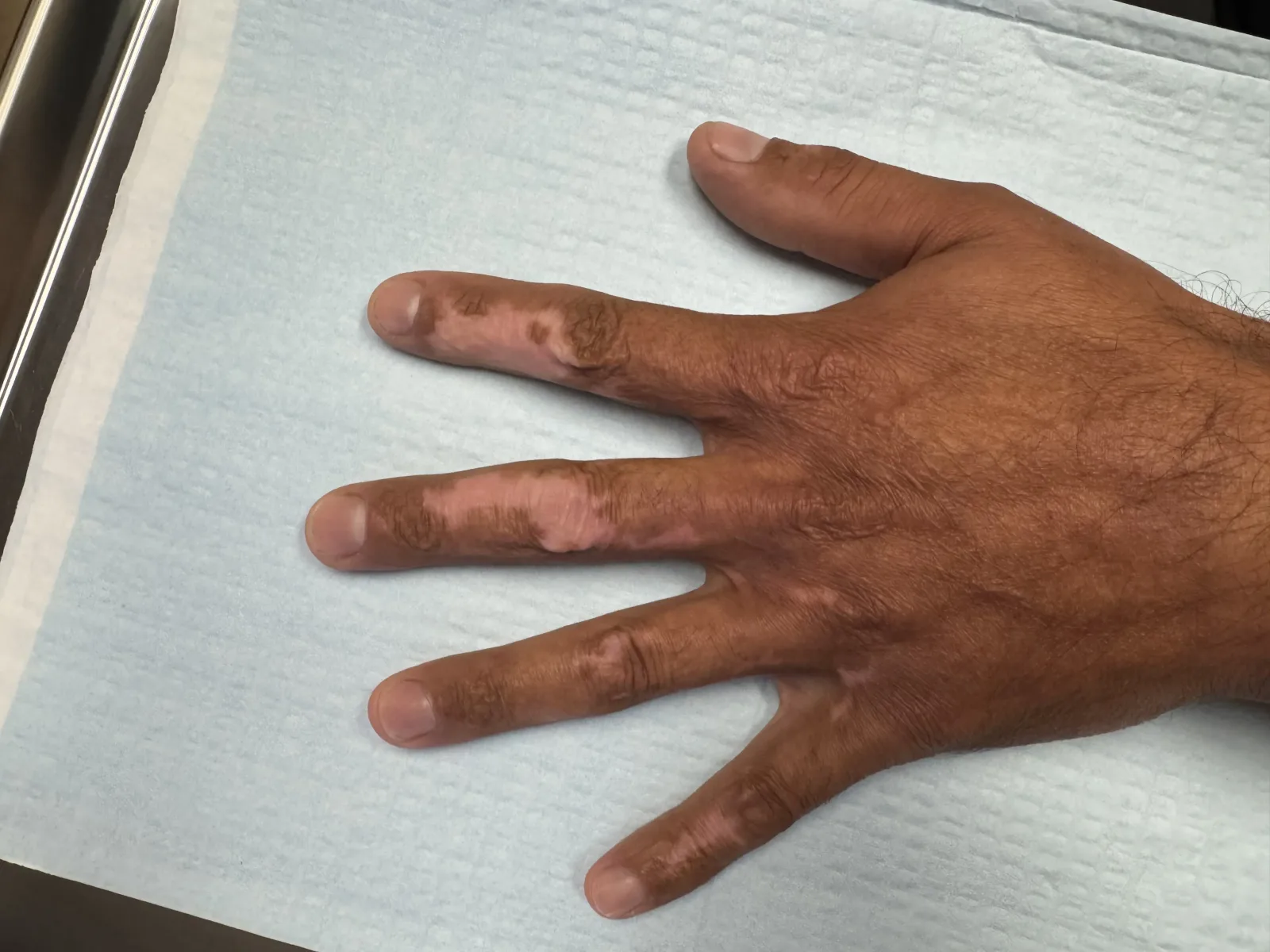 Hand scar and hyperpigmentation before treatment