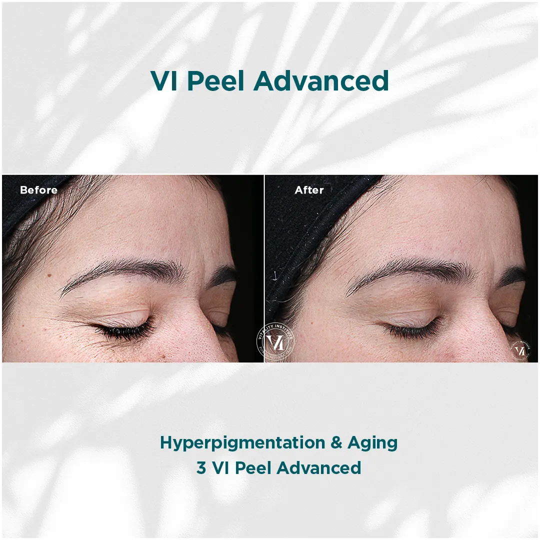 Eye area hyperpigmentation and aging before and after 3 VI Peel Advanced