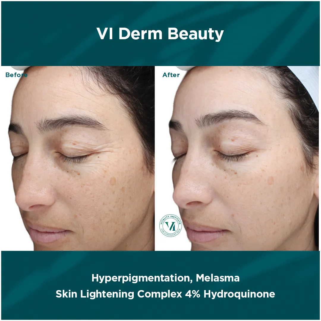 Hyperpigmentation and melasma before and after VI Derm Skin Lightening Complex 4% Hydroquinone