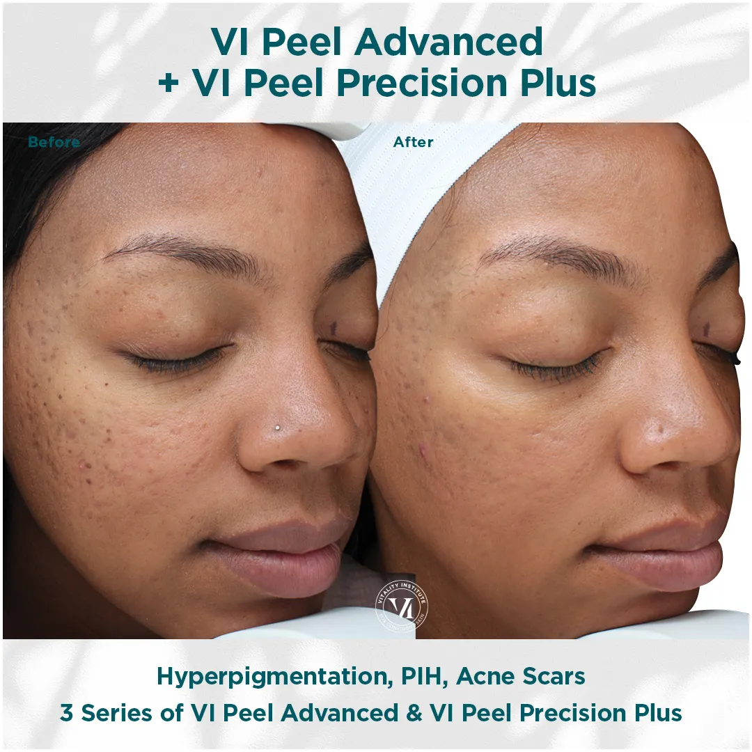 Acne, acne scarring and PIH on deep skin tone before and after 3 VI Peel