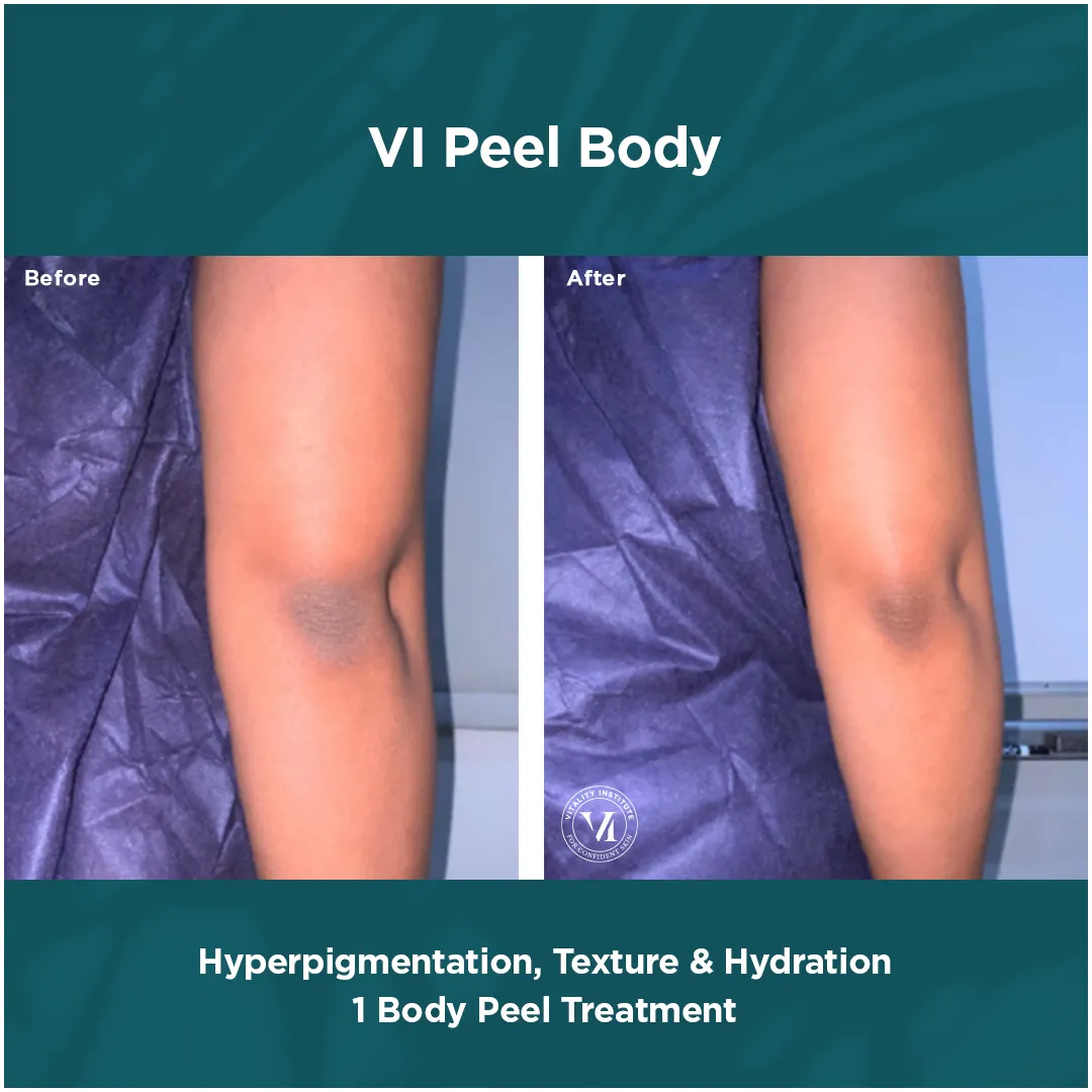 Elbow hyperpigmentation, texture and dryness before and after 1 VI Peel Body treatment