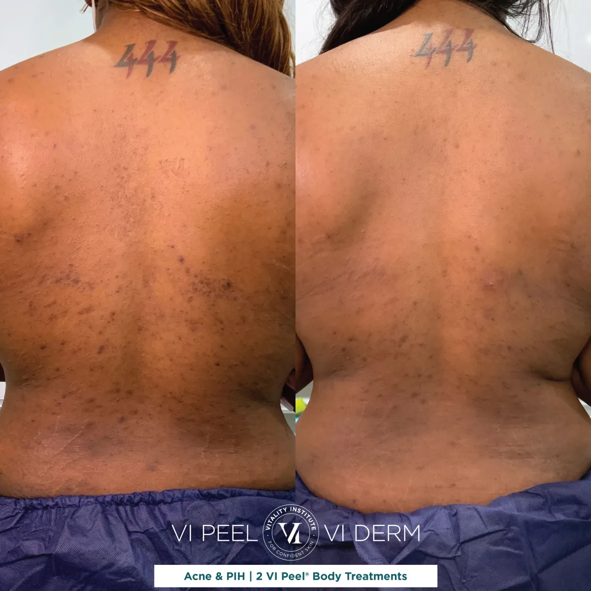 Back acne and PIH on deep skin tone before and after 2 VI Peel Body treatments