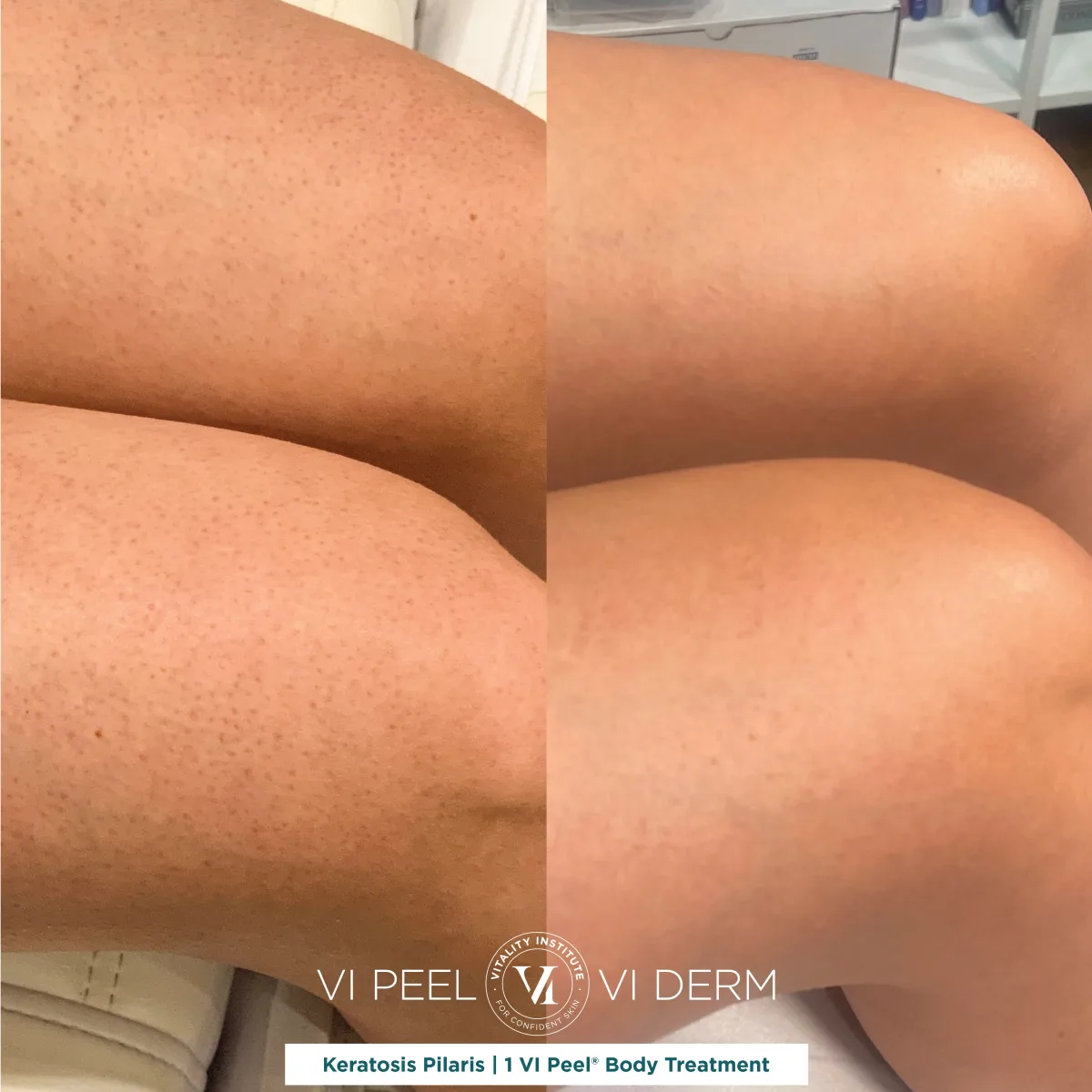 Keratosis pilaris on legs before and after 1 VI Peel Body treatment