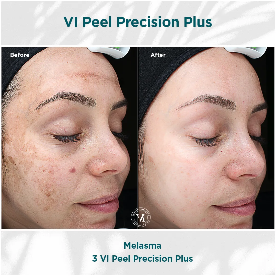Severe facial melasma before and after 3 VI Peel Precision Plus sessions