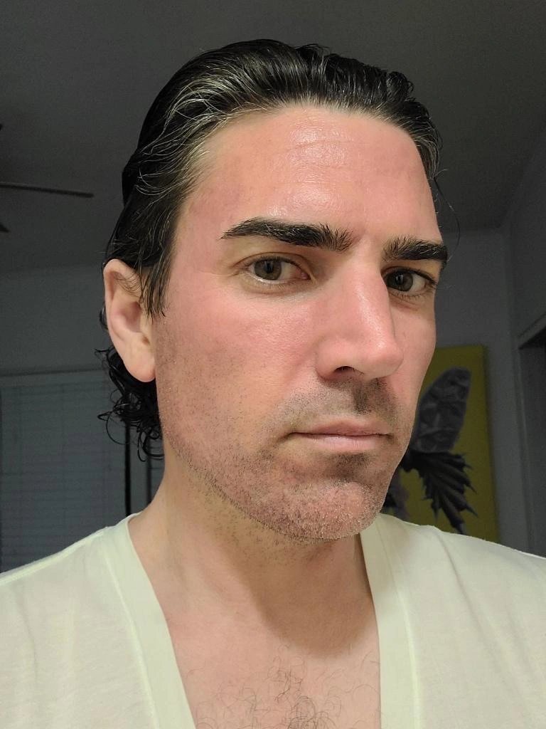 Male client before micro channeling treatment