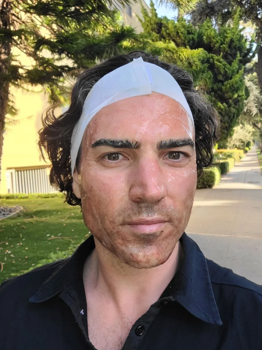 Male client healing process after micro channeling