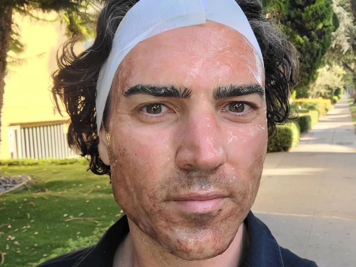Male client post-microneedling healing outdoors