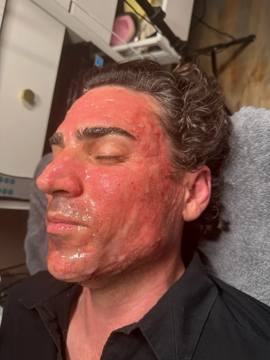 Male client during micro channeling — redness immediately after