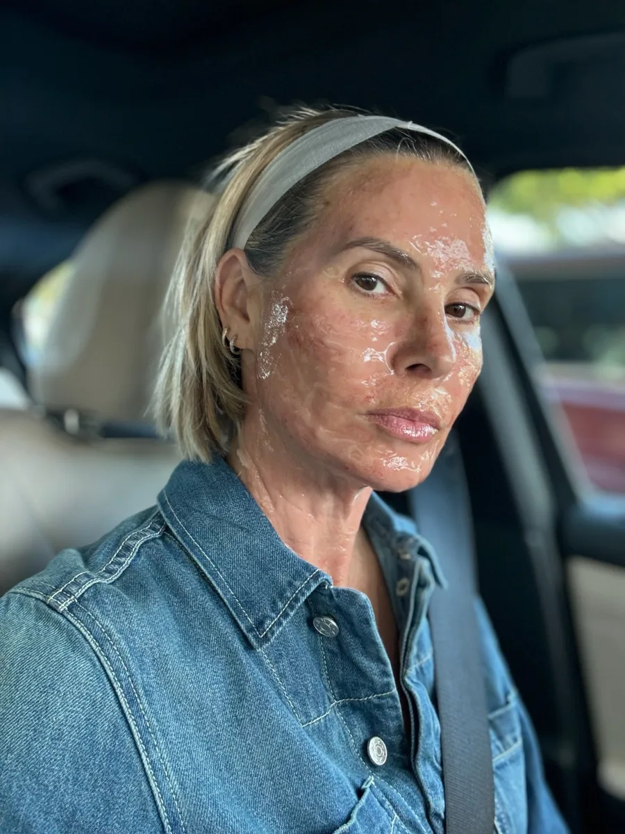 Female client post-micro channeling with healing ointment applied