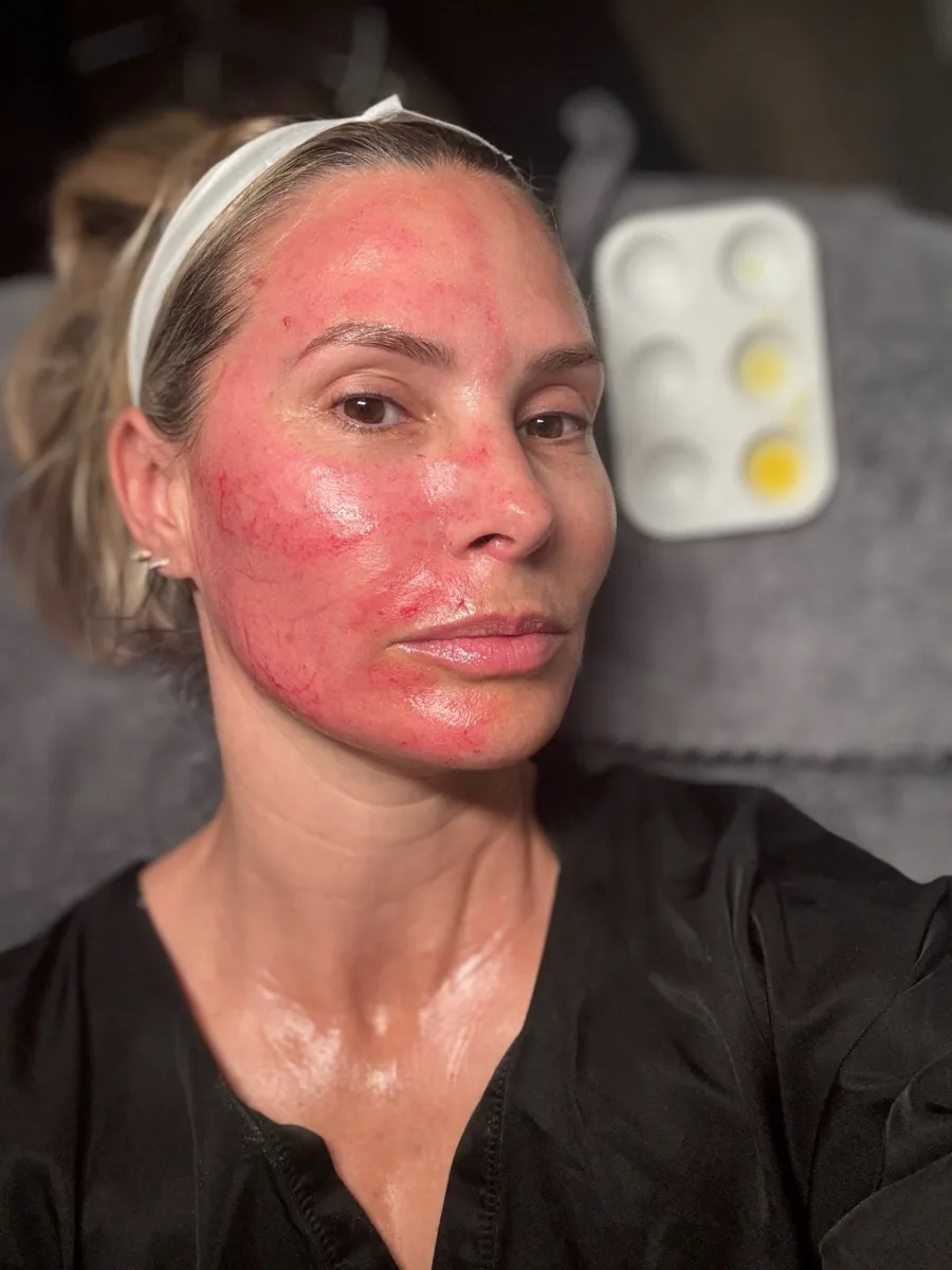 Female client during micro channeling — redness response
