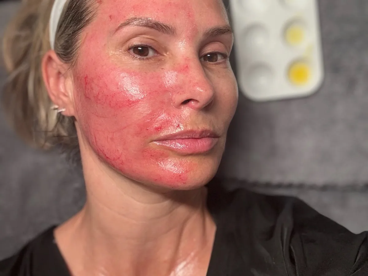 Female client post-microneedling on treatment table