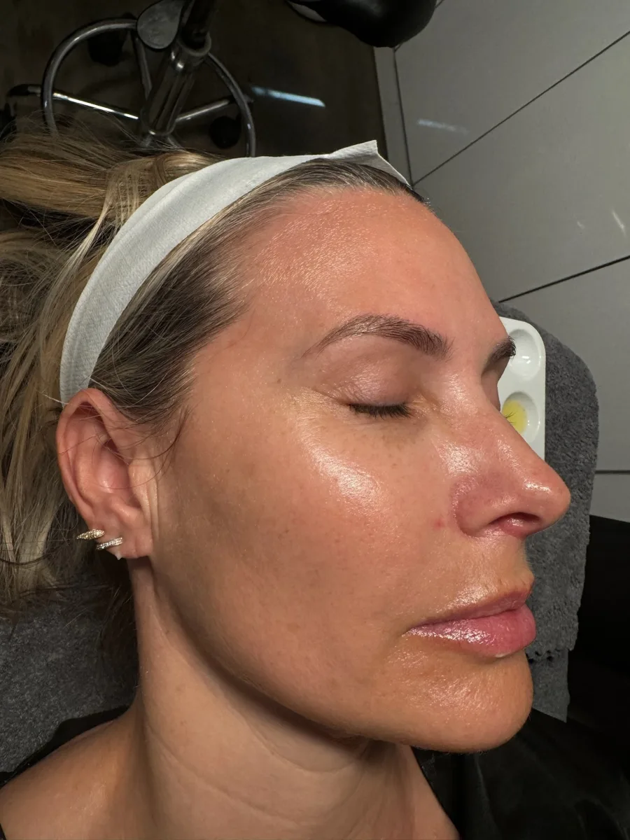 Female client after micro channeling — skin texture improved