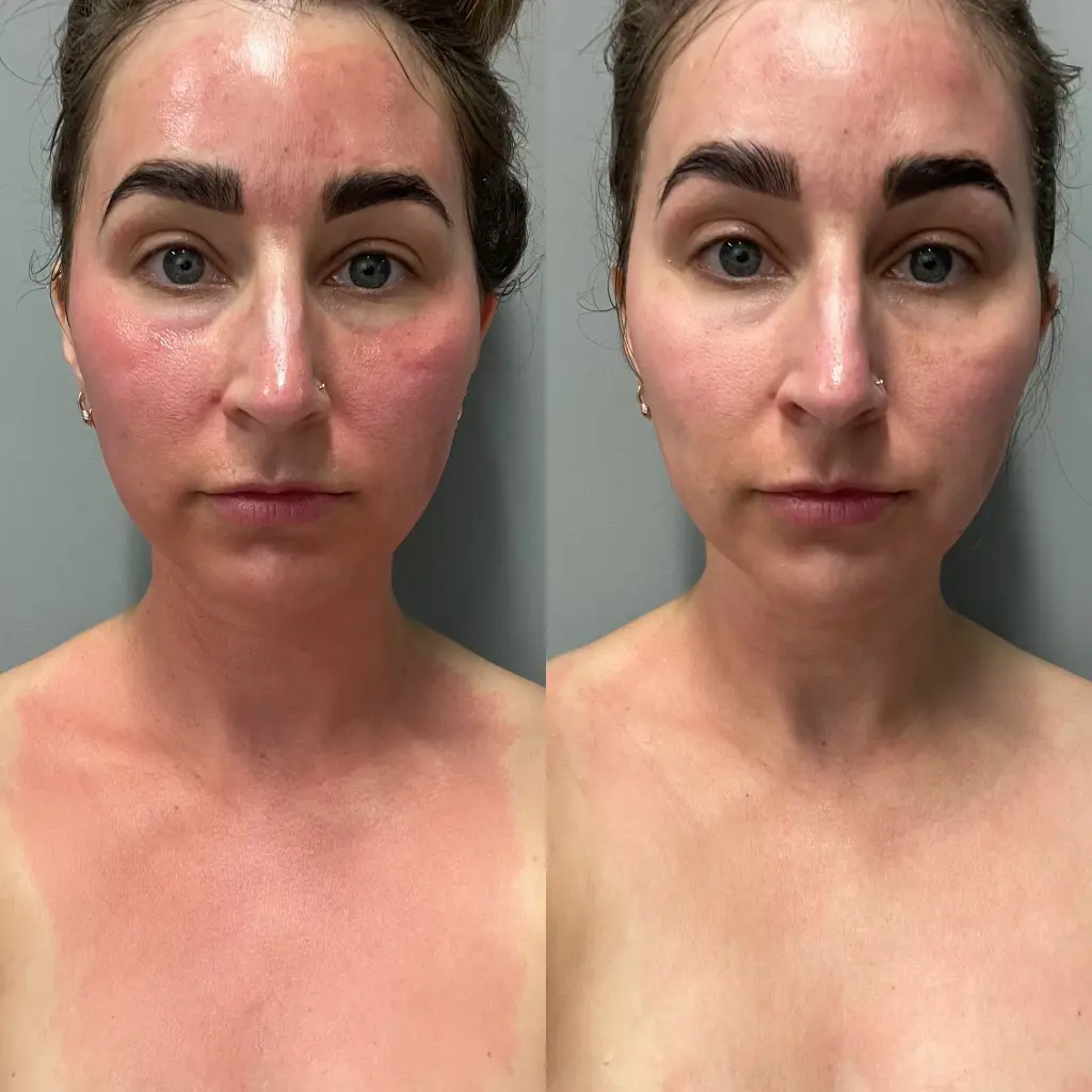 Before and after micro channeling for redness and rosacea