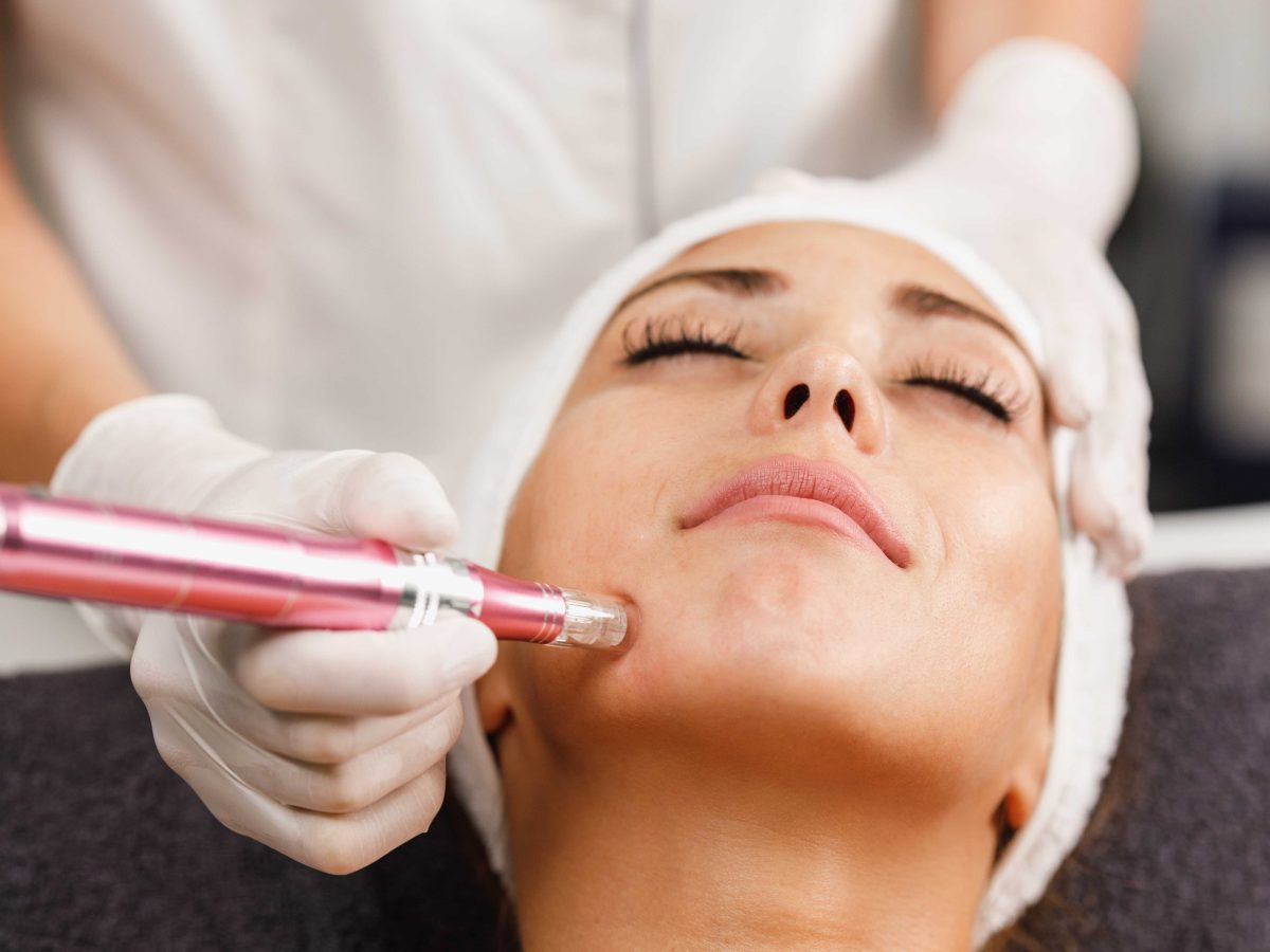 Microneedling