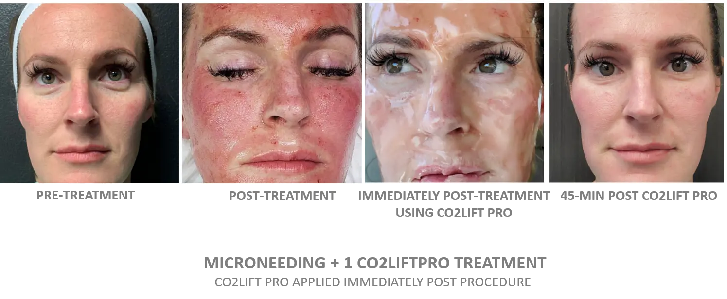 Micro Channeling + CO2Lift Pro — four-stage treatment documentation