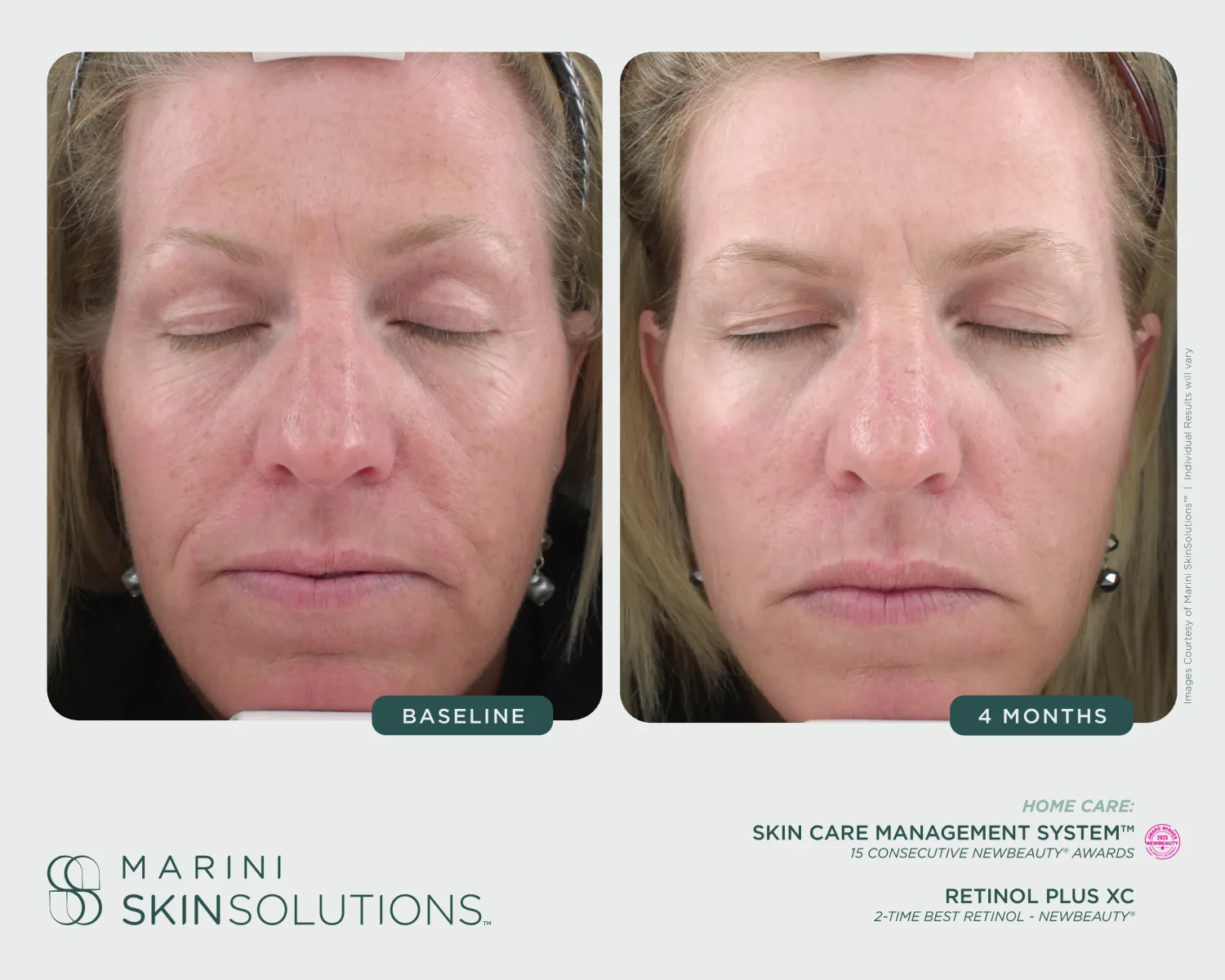 Facial redness and wrinkles before and after SCMS + Marini Luminate XC — 2 months