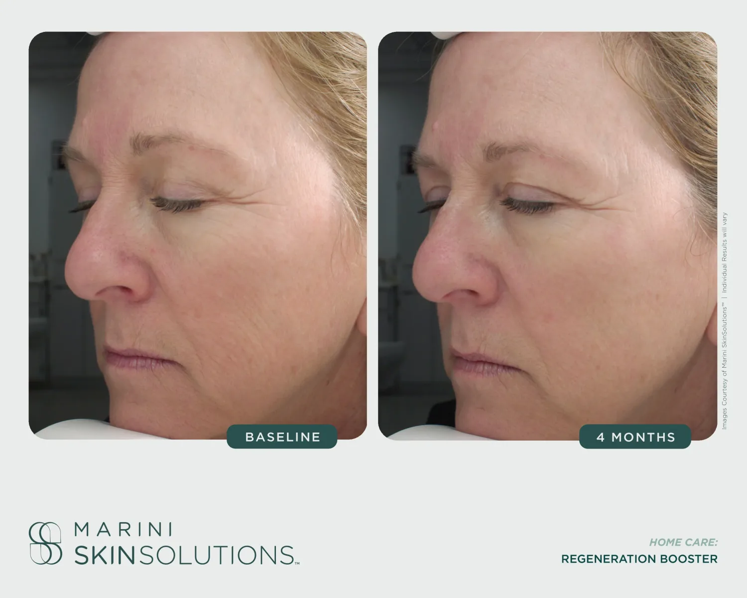 Facial wrinkles before and after Regeneration Booster — 4 months