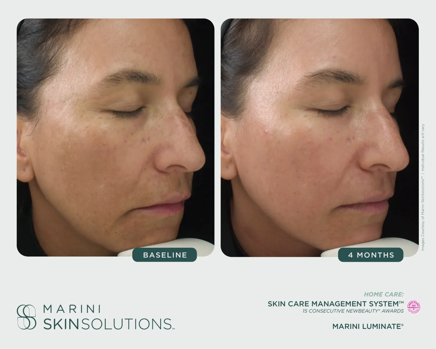 Deep skin tone hyperpigmentation before and after Clarify Peel + Marini Luminate — 4 months