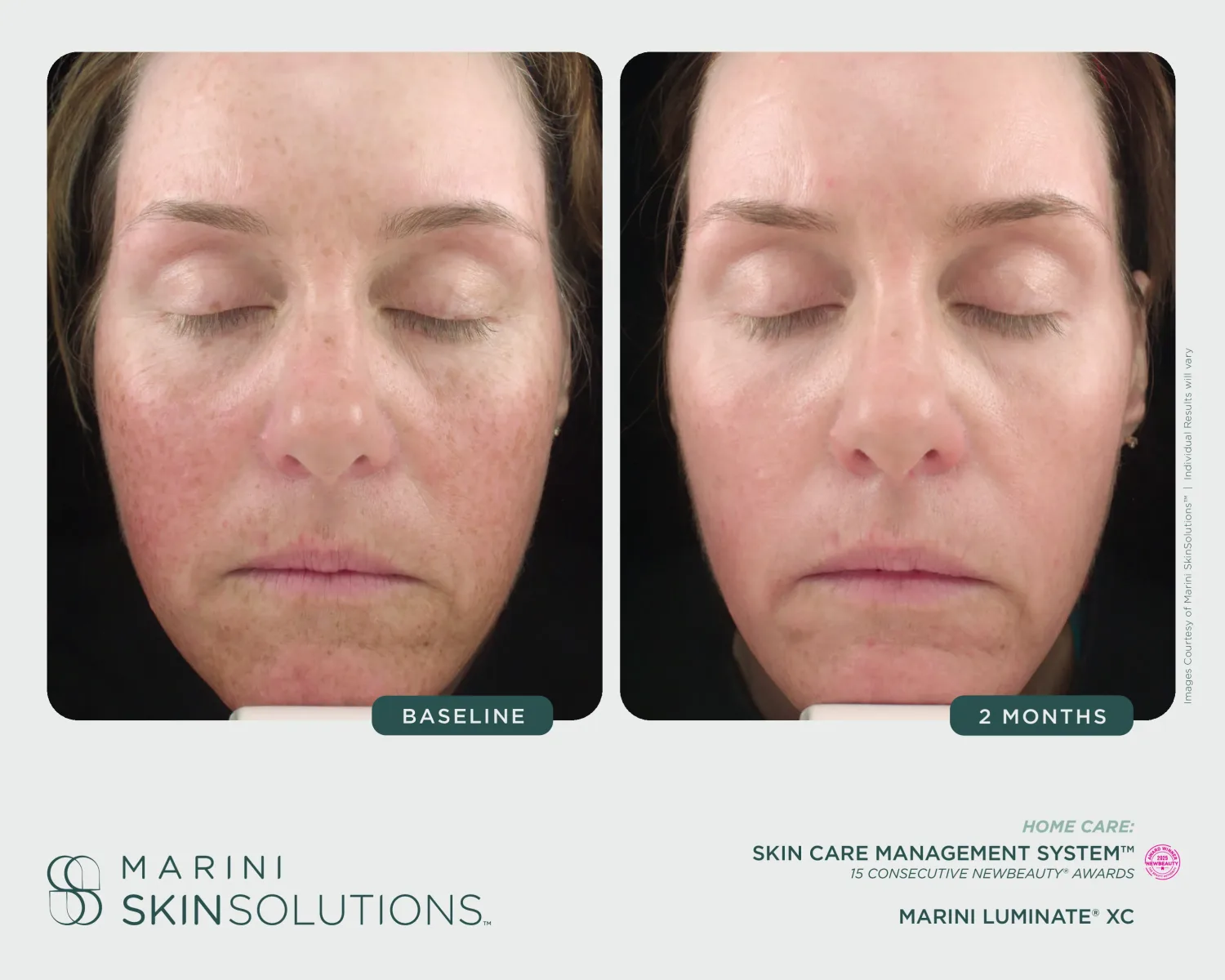 Facial redness before and after laser + Rosalieve — 3 months