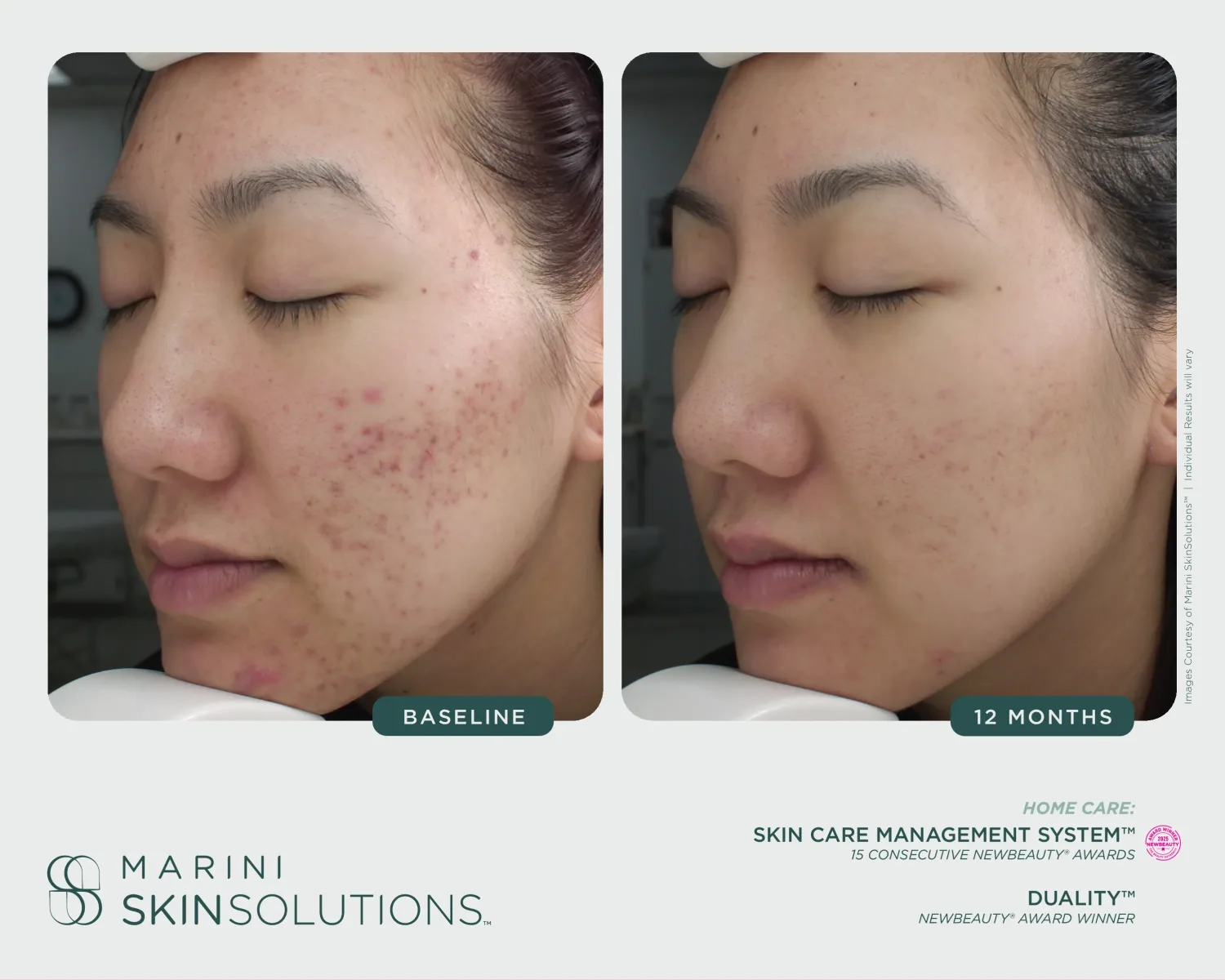 Facial discoloration before and after Transform Peel + SCMS — 15 weeks