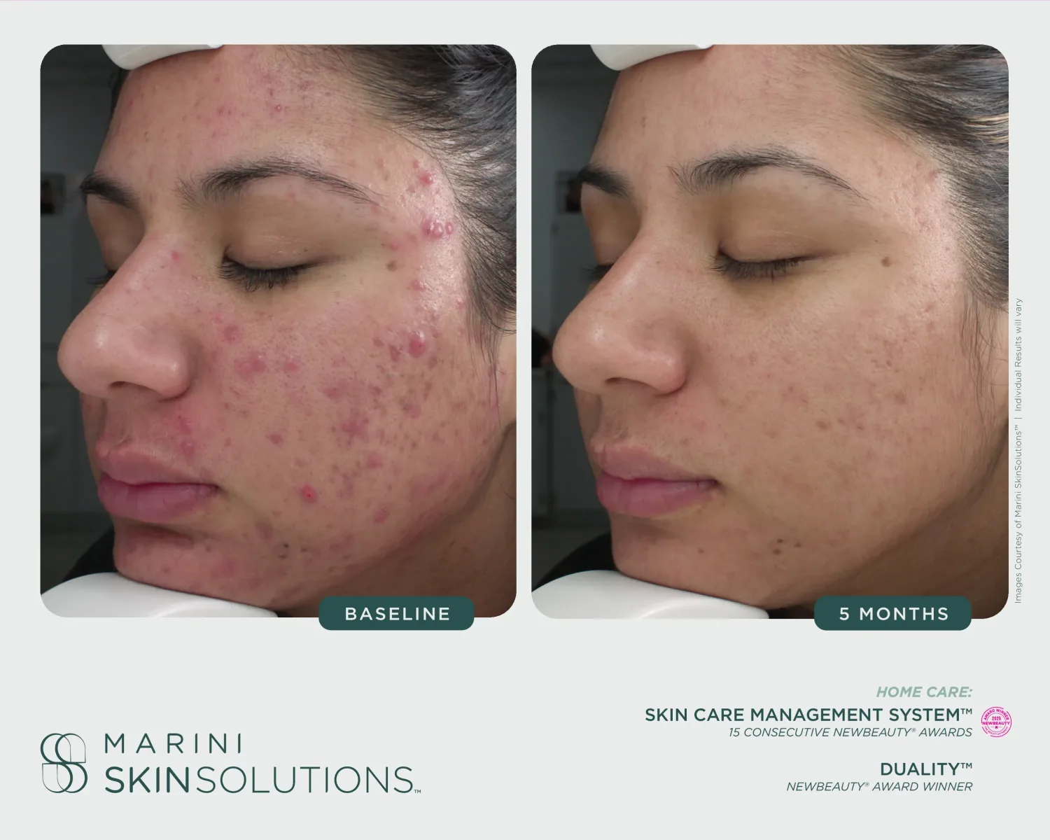 Hand age spots and texture before and after Marini Renu — 2 months