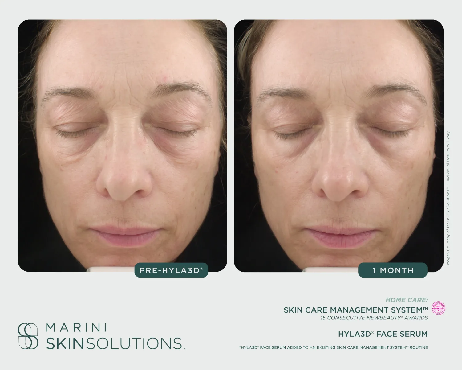 Active acne before and after Marini SCMS + Duality — 5 months