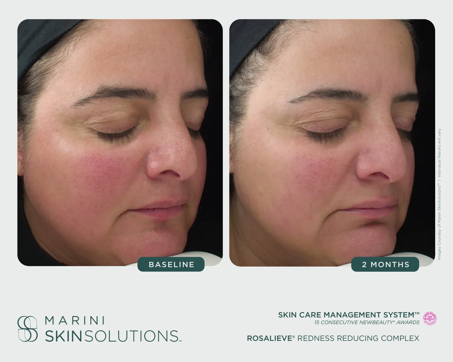 Hand redness before and after — Transform Peel + Marini Renu, 3 months