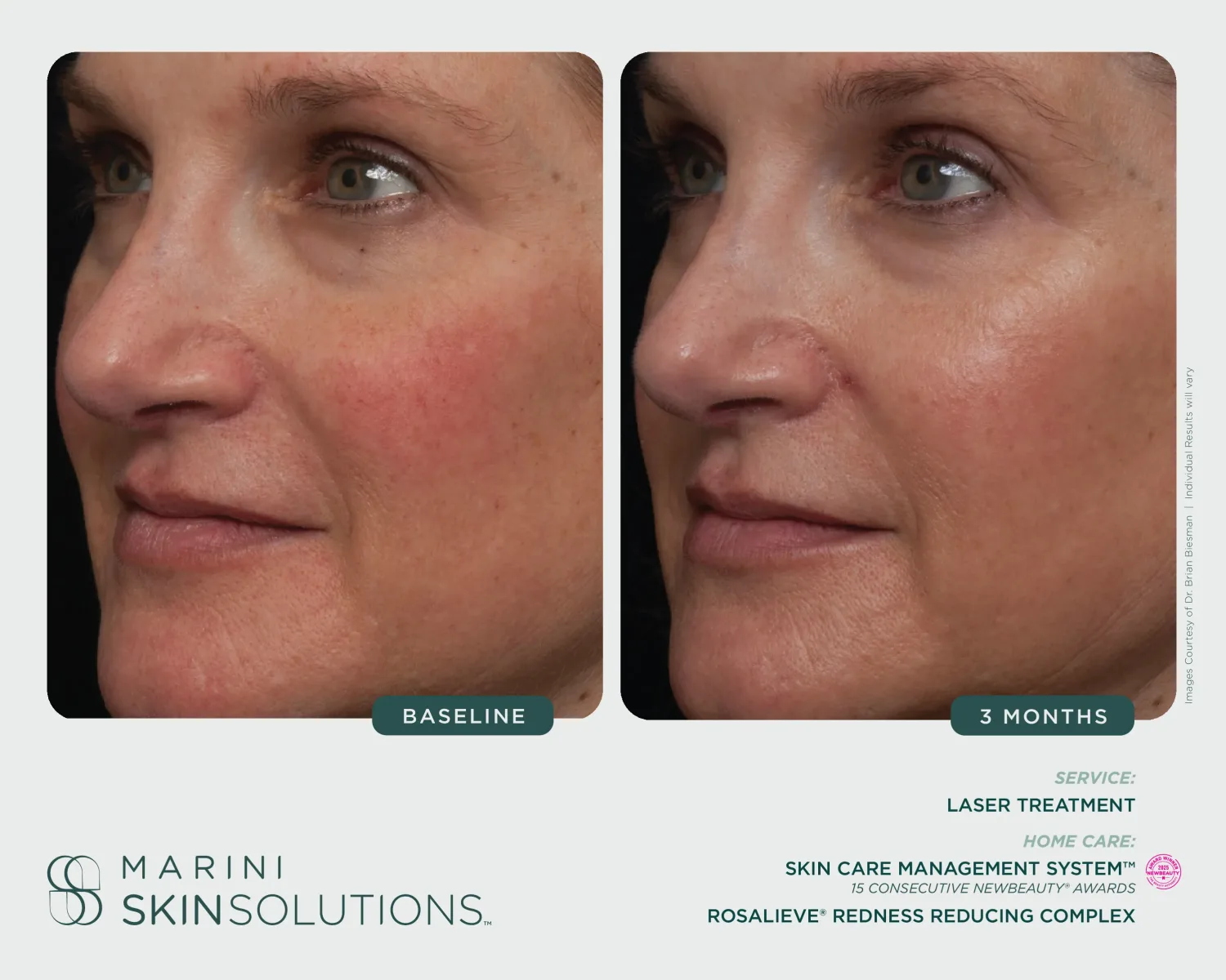 Under-eye volume and wrinkles before and after Hyla3D — 1 month
