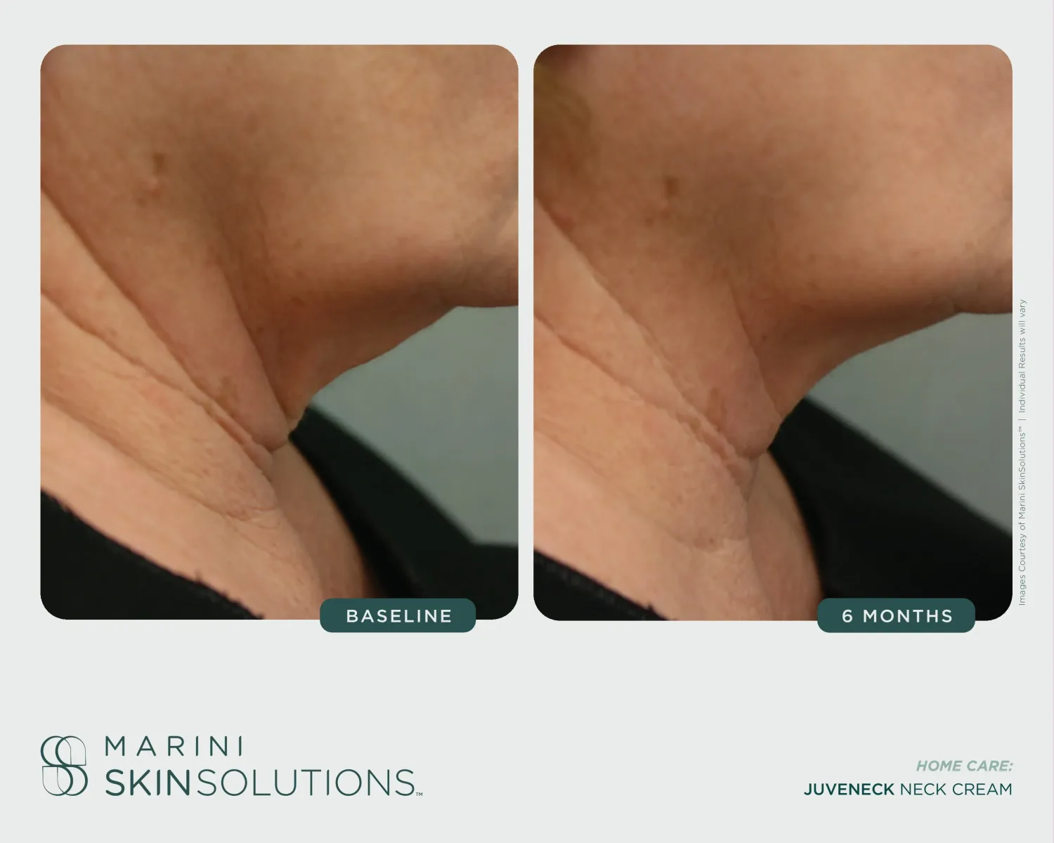 Neck tech-neck lines before and after Juveneck — 6 months