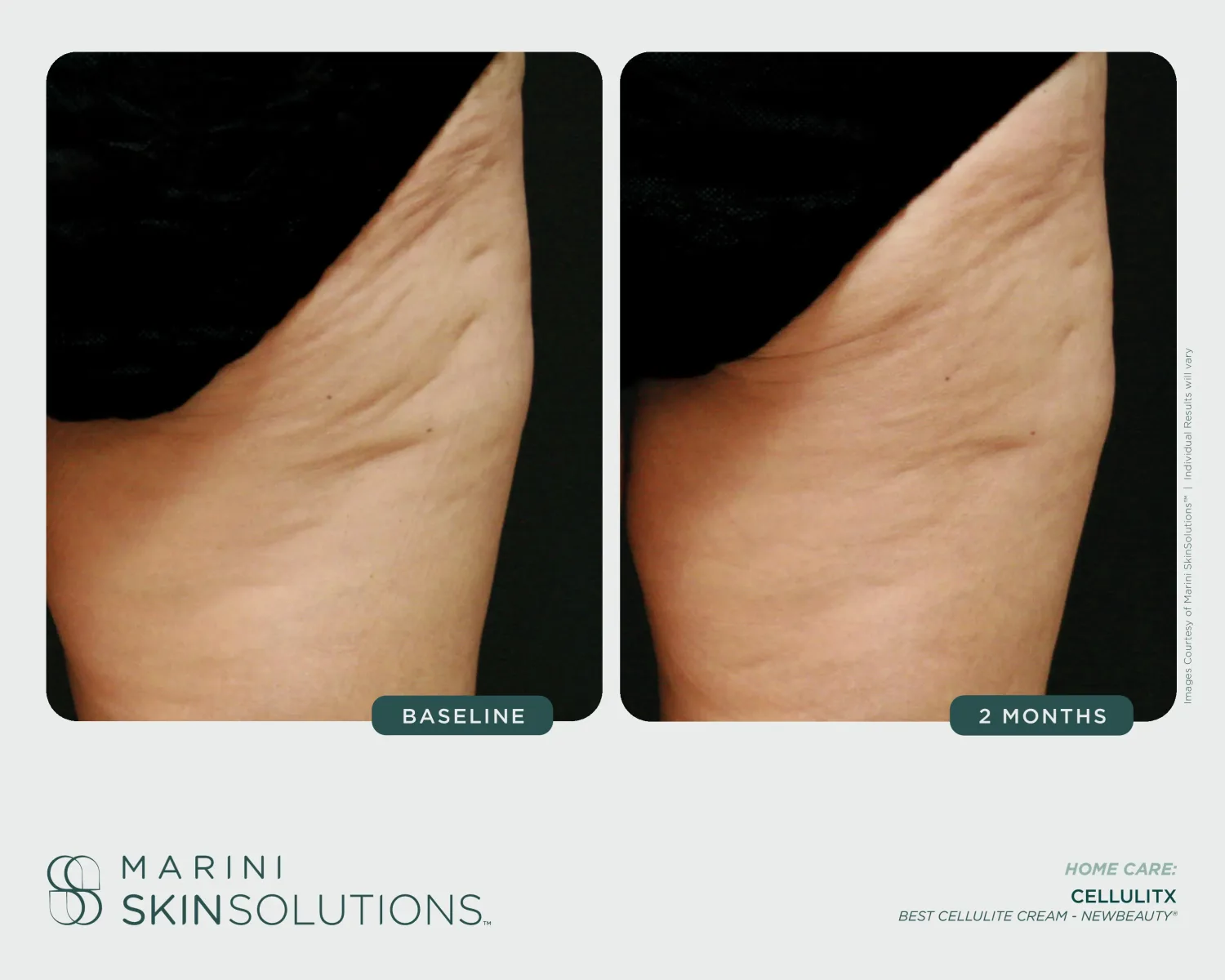 Acne before and after Marini SCMS + Duality — 12 months