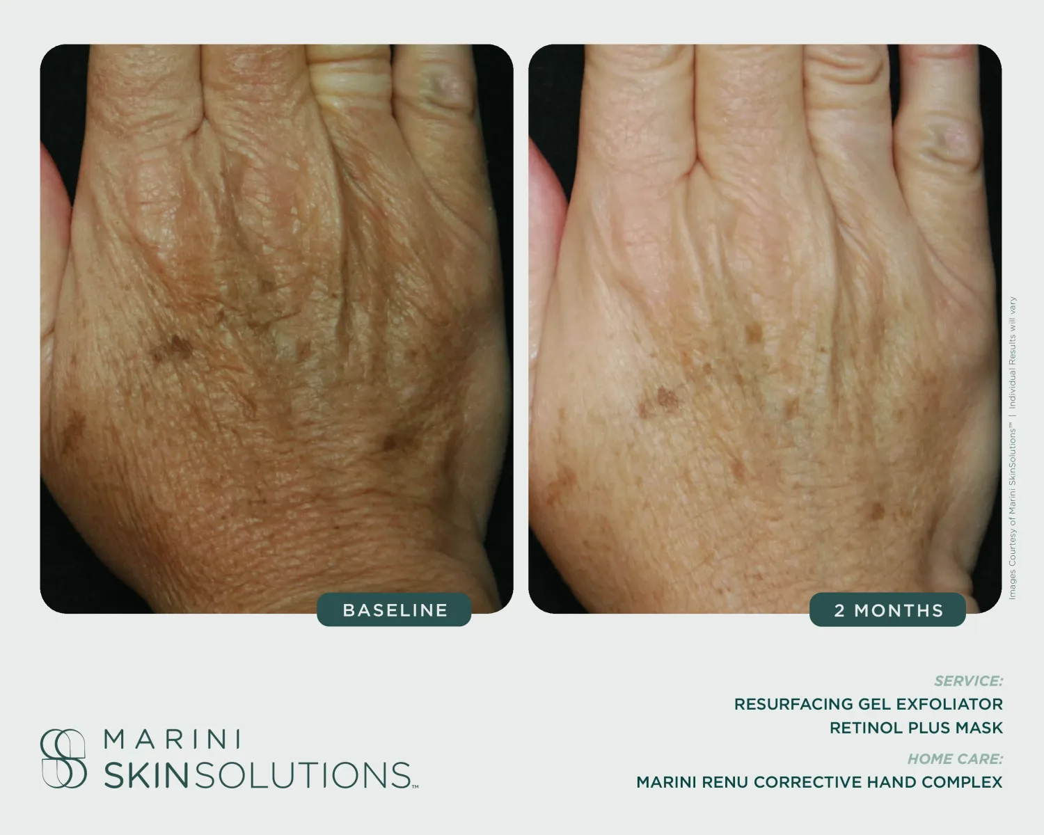 Facial wrinkles before and after SCMS + Retinol Plus XC — 4 months