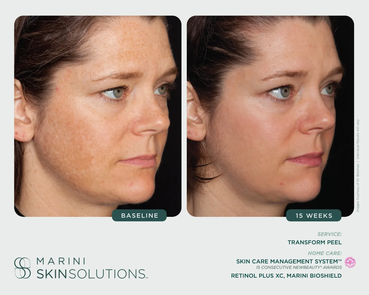 Facial pigmentation before and after Marini Luminate — 4 months