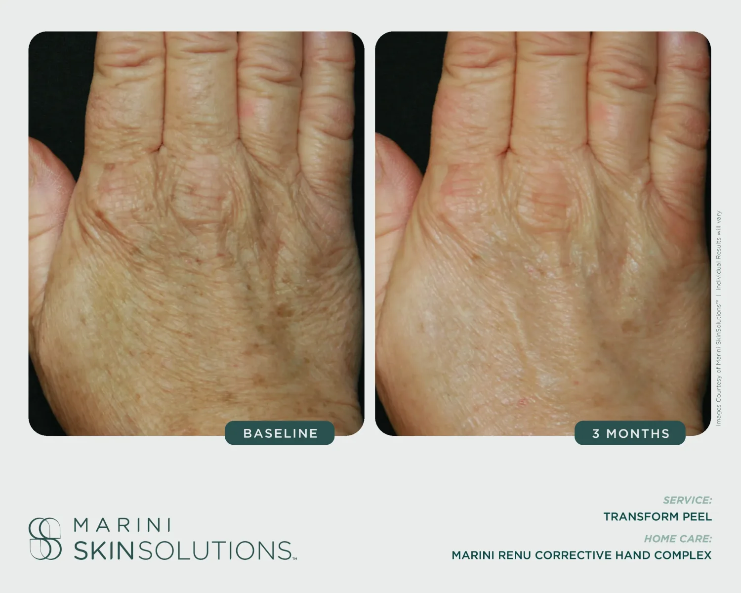 Upper arm cellulite before and after CellulitX — 1 month