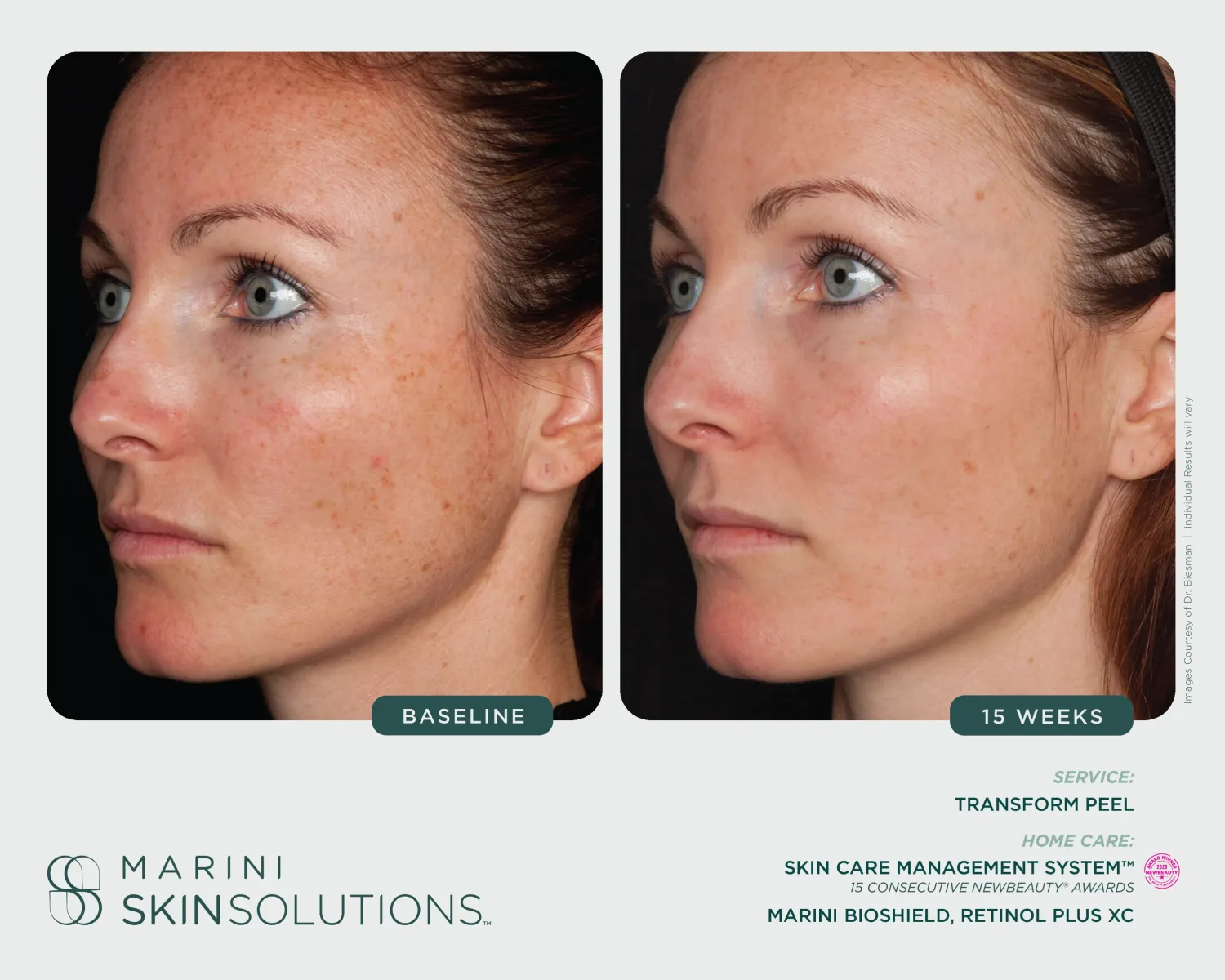 Facial sun damage and freckles before and after Transform Peel + Marini Bioshield — 15 weeks