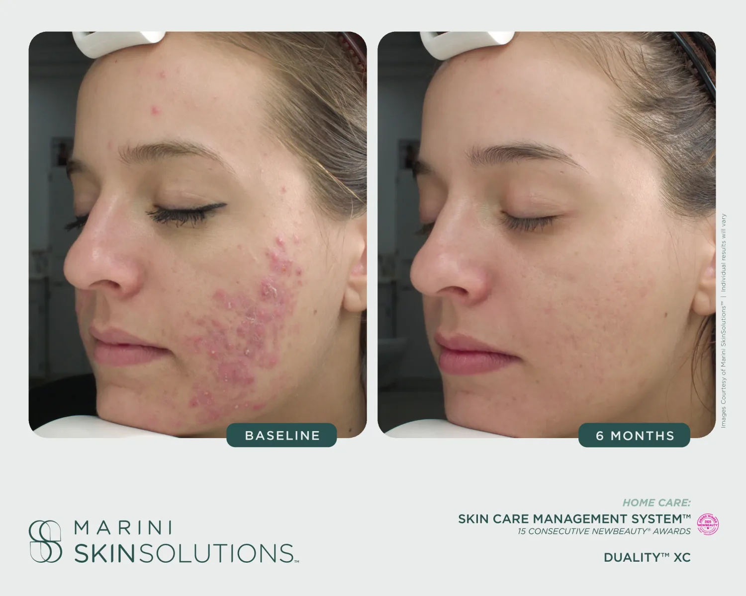 Severe cystic acne before and after Marini SCMS + Duality XC — 6 months