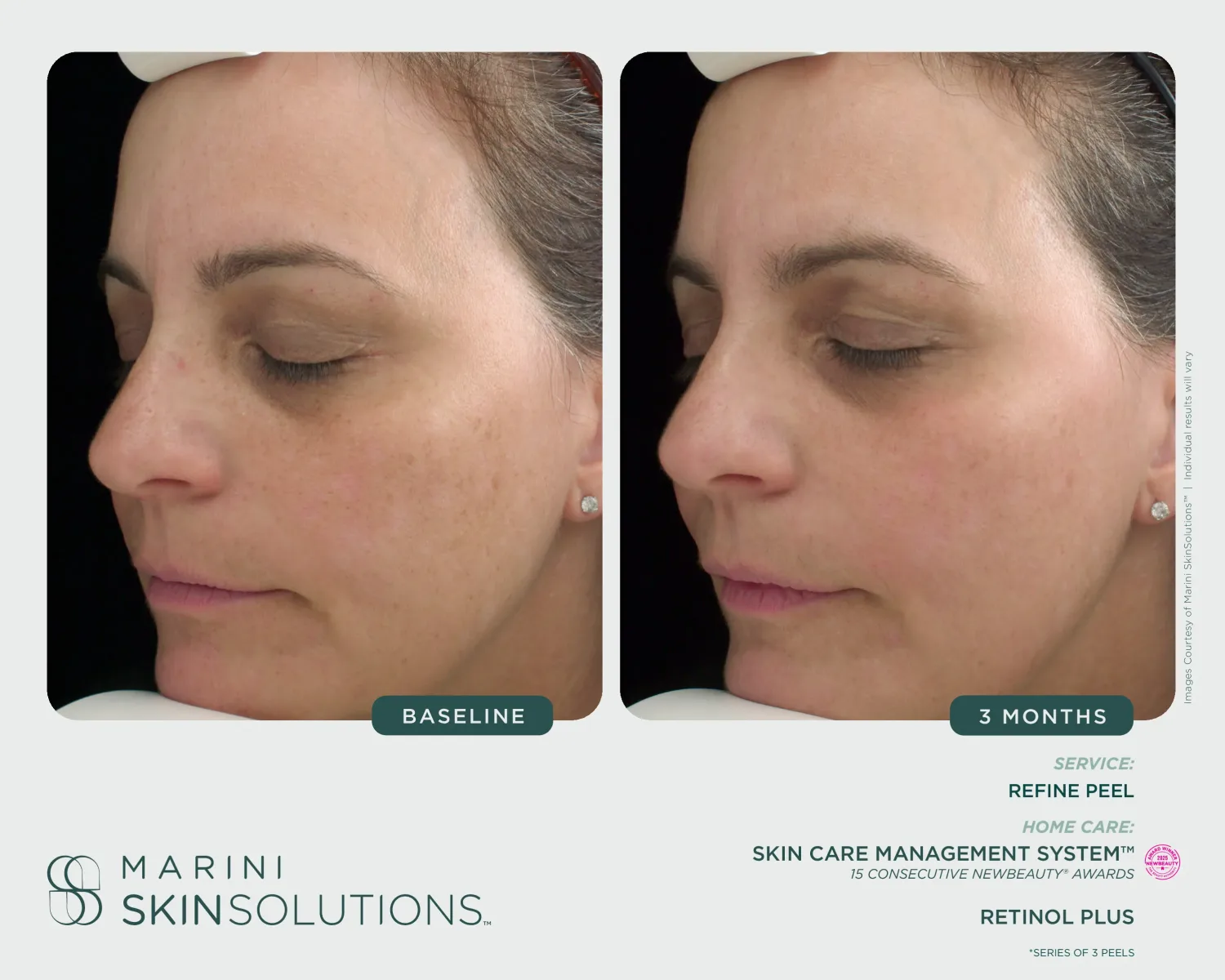 Facial aging and pigmentation before and after Refine Peel series + Retinol Plus — 3 months