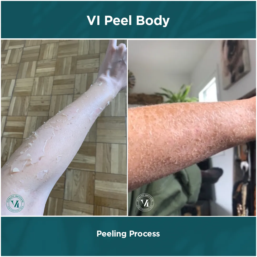 VI Peel Body peeling process on forearm, dual panel