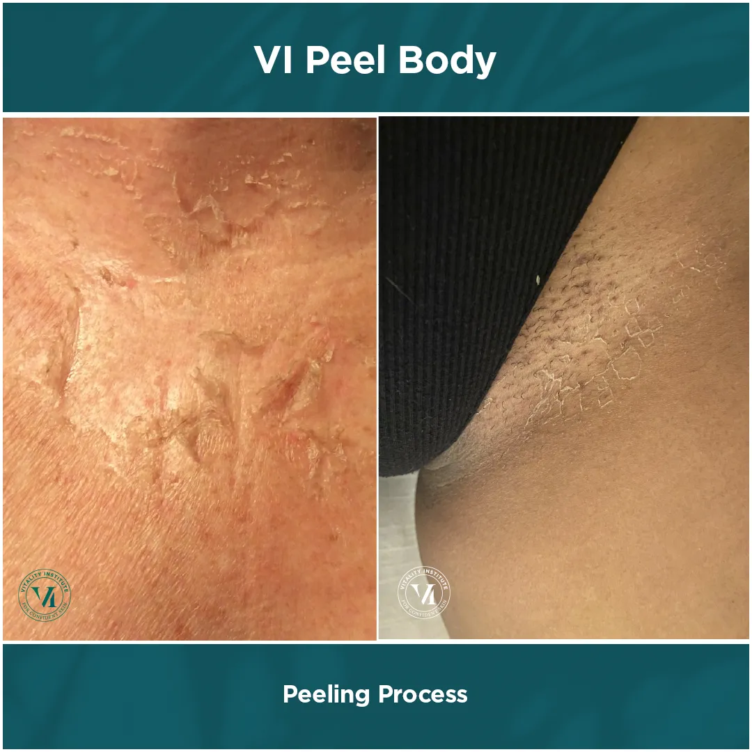 VI Peel Body peeling process close-up dual panel — stretch mark area and underarm