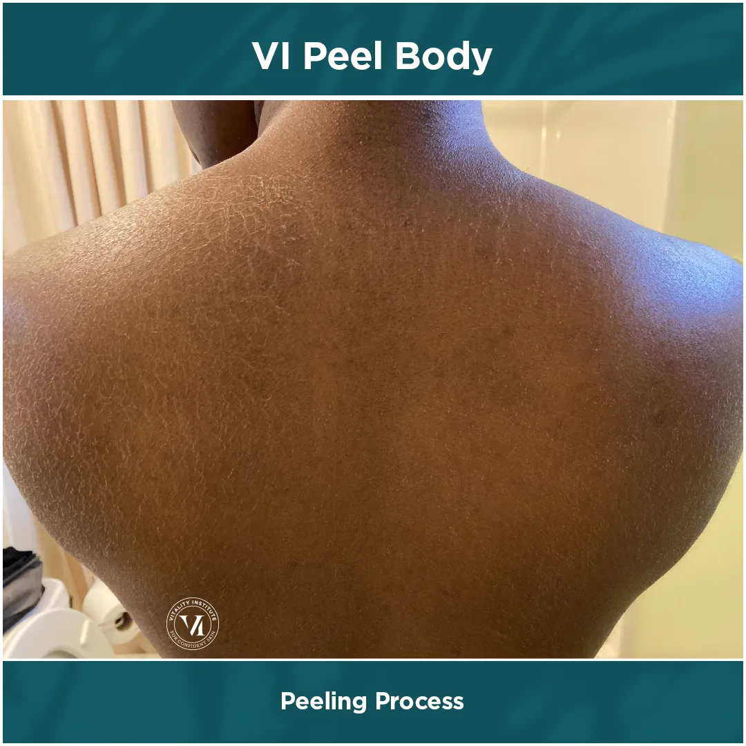 VI Peel Body peeling process on full back, deep skin tone