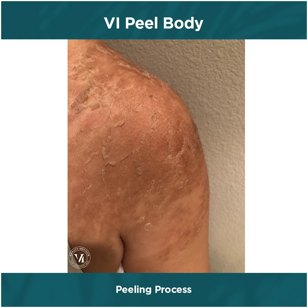 VI Peel Body heavy peeling process on shoulder