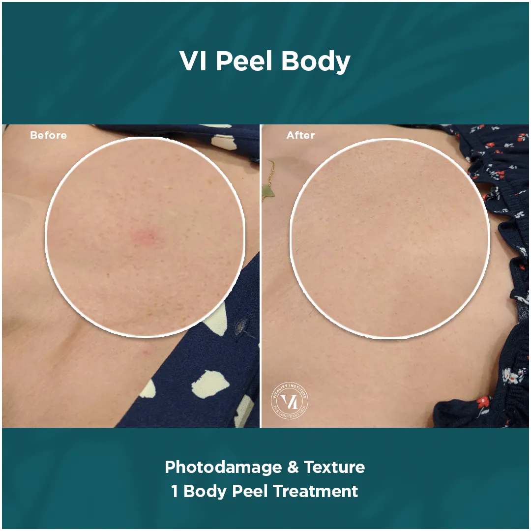 Chest photodamage and texture before and after 1 VI Peel Body treatment