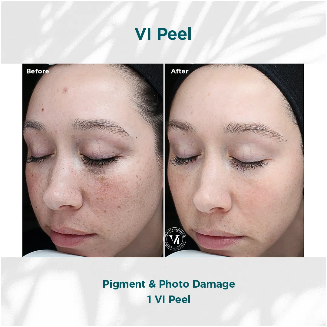 Facial pigmentation and photo damage before and after 1 VI Peel