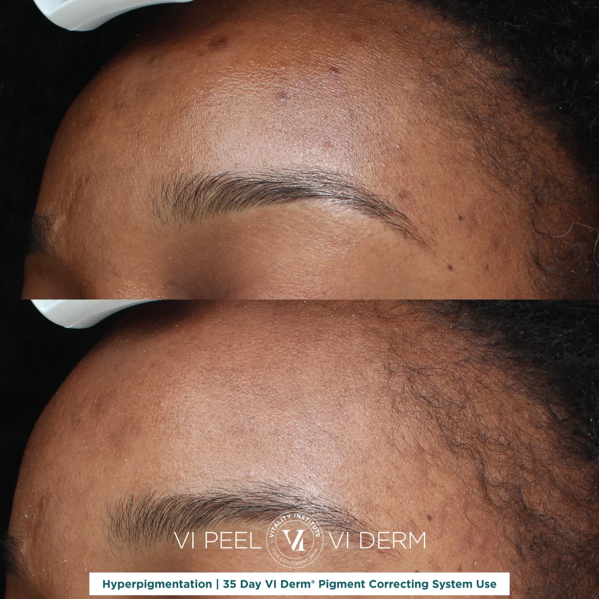 Forehead hyperpigmentation on deep skin tone before and after VI Derm Pigment Correcting System — 35 days