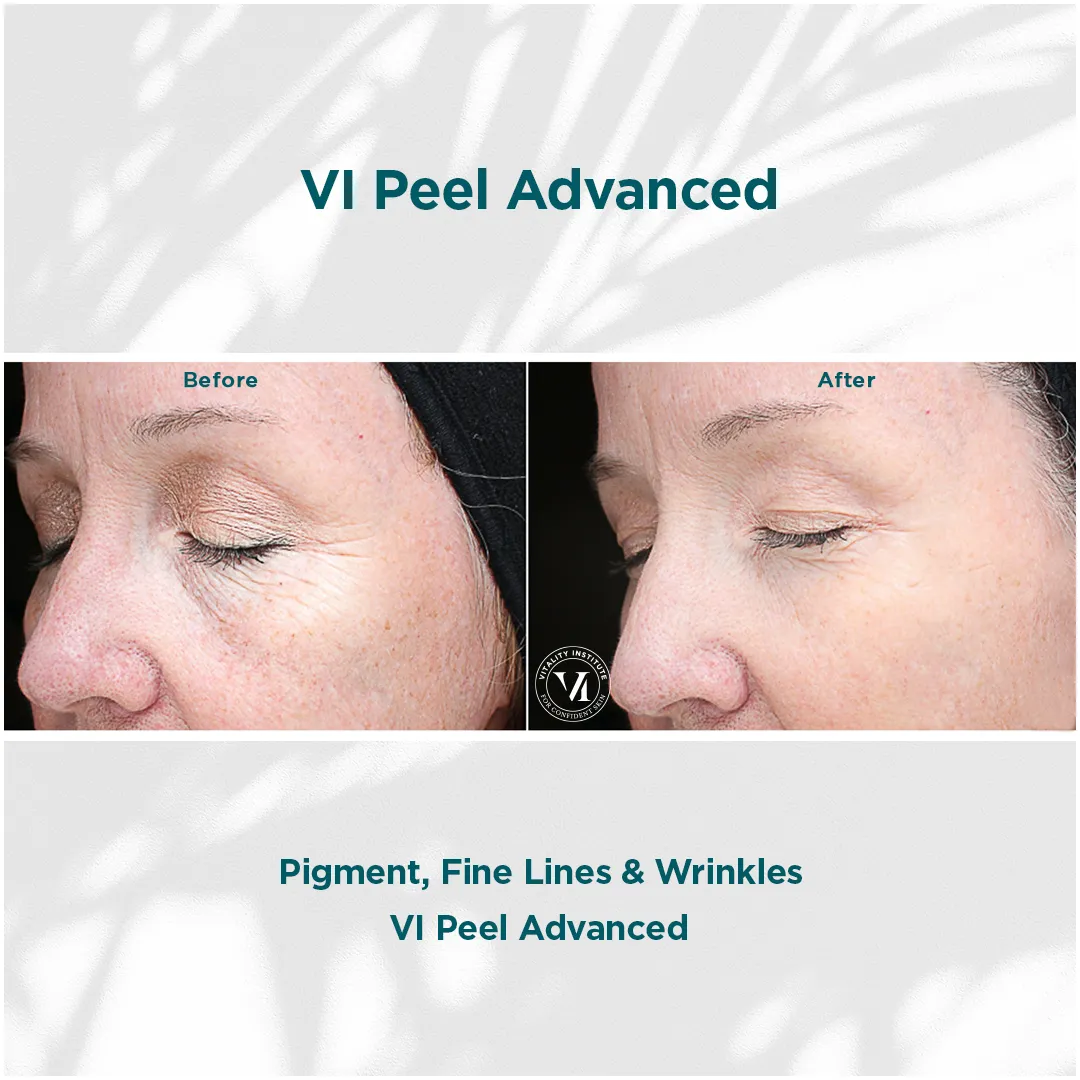 Periorbital pigmentation, fine lines and wrinkles before and after 1 VI Peel Advanced